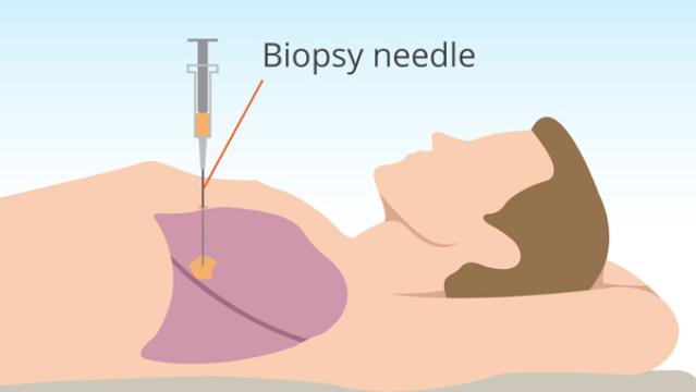 Needle Biopsy Market