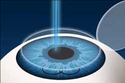 Global Custom Lasik Market 