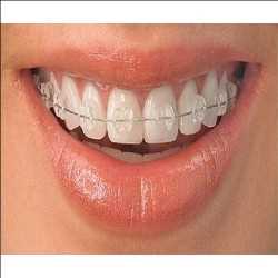 Global Orthodontics Dental Consumables Market 