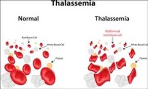 Global Alpha Thalassemia Market Forecast