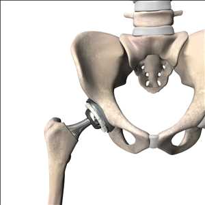 Global Artificial Hip Joint Market Growth