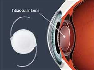 Global Artificial Lens Market Insights