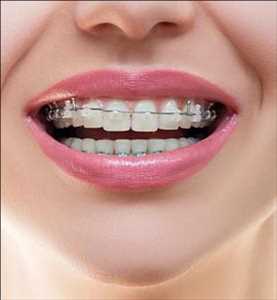 Global Ceramic Braces Market Analysis