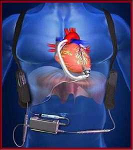 Global Congestive Heart Failure (Chf) Treatment Devices Market Forecast