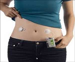 Global Continuous Glucose Monitoring (CGM) Market Insights