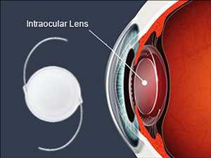 Global Intraocular Lens Market Demand