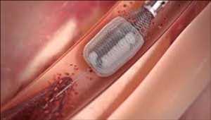 Global Mechanical Thrombectomy Devices Market Analysis