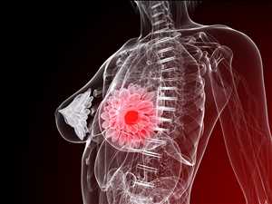 Global Metastatic Breast Cancer Treatment Market Industry