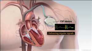 Cardiac Resynchronization Therapy Device Market