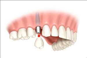 Dental Implant And Prosthetics Market