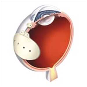 Glaucoma Eye Surgery and Drainage Devices Market