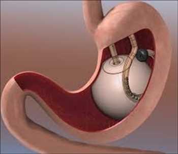 Global Intragastric Balloons Market Future Data