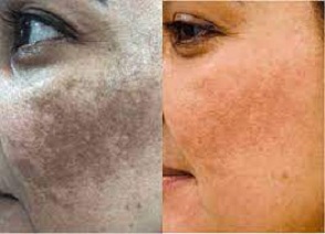 Global Pigmentation Disorders Treatment Market Opportunities