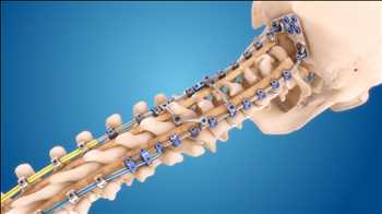Global Spine Surgery Product Market Leading Players