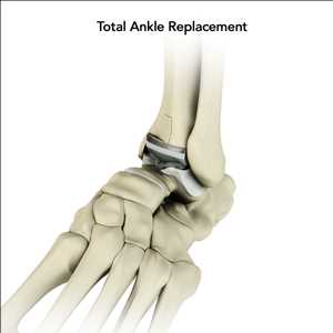 Total Ankle Arthroplasty Market