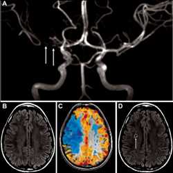 Cerebrovascular Imaging