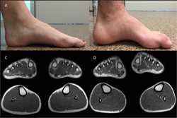 Charcot-Marie-Tooth Disease Type I