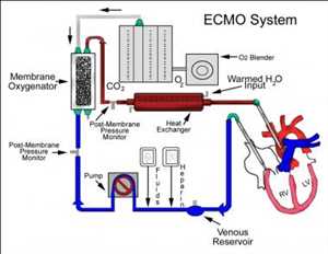 Global Extra Corporeal Membrane Oxygenation (ECMO) Market Insights