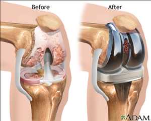 Global Knee Implants Market Trend