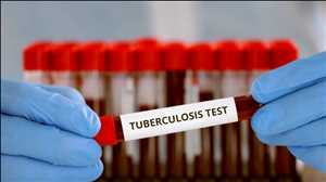 Global Latent Tuberculosis Infection (LTBI) Testing Market Trend