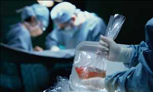 Global Organ Transplantation Market Demand