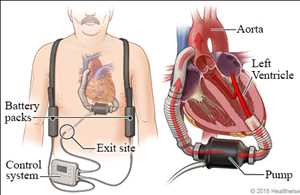 Global Ventricle Assist Device Market Industry