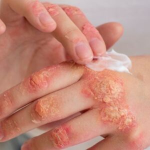 Fungal Infection Diagnosis