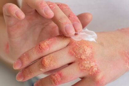 Fungal Infection Diagnosis