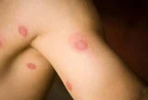 Fungal Infection Diagnosis