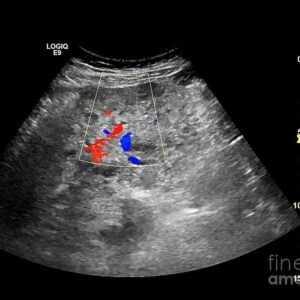 Liver Cancer Diagnostics