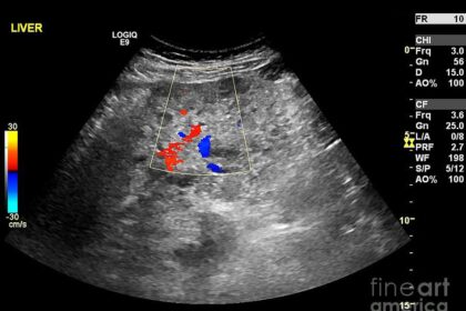 Liver Cancer Diagnostics