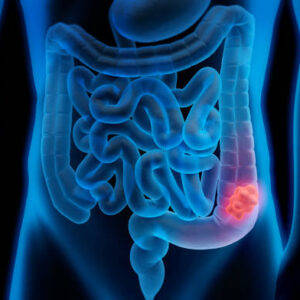 Colon Cancer Diagnostic