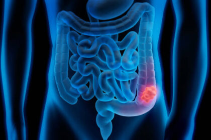 Colon Cancer Diagnostic